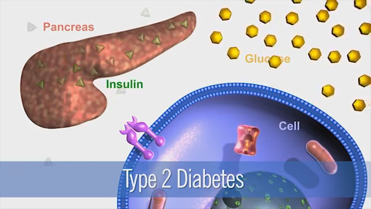 Type 2 diabetes diagram
